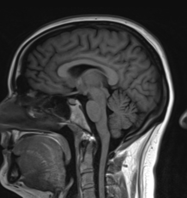 brain mri