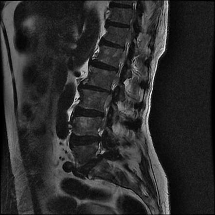Can I get a spine MRI if I have metal implants?