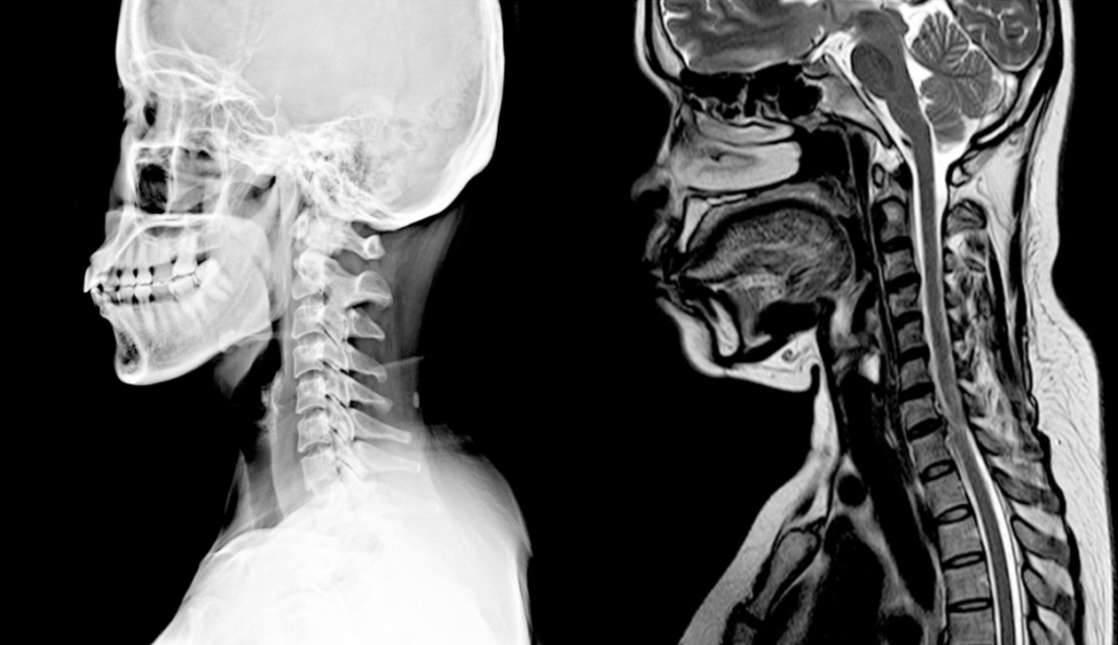 MRI Cervical Spine Lucknow