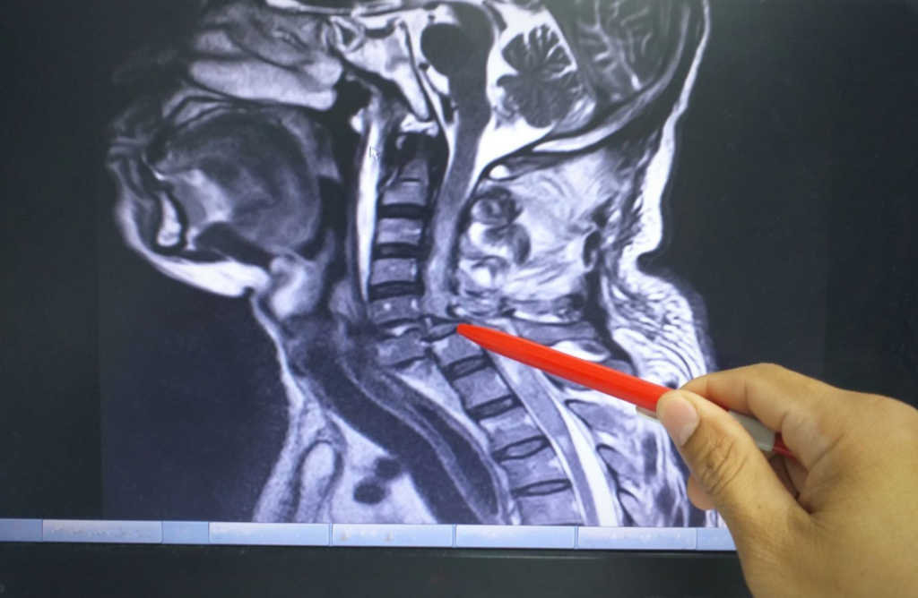 cervical spine mri