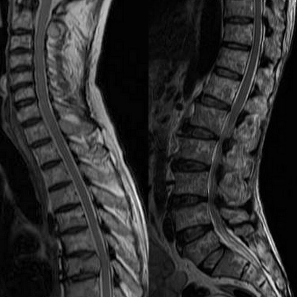 spine MRI lucknow