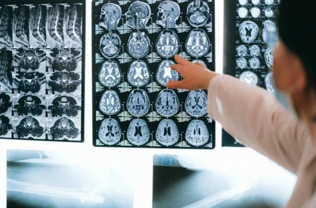 Do all health insurance plans cover MRI scans?