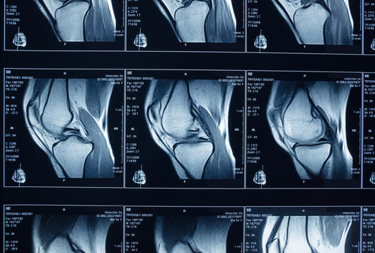 knee mri