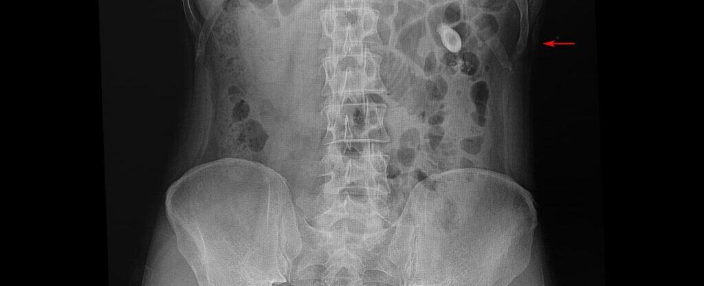 Can You See a Kidney Stone on X Ray