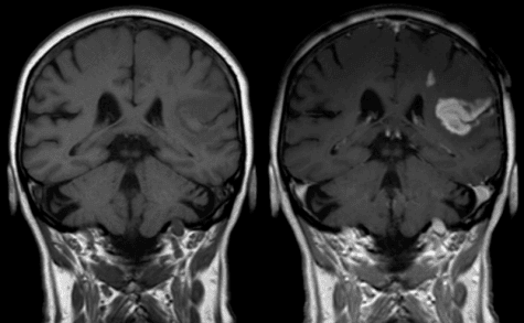 brain mri contrast