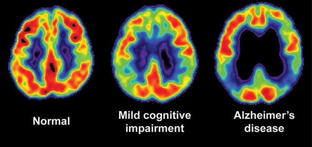 Can Brain Imaging Detect Dementia