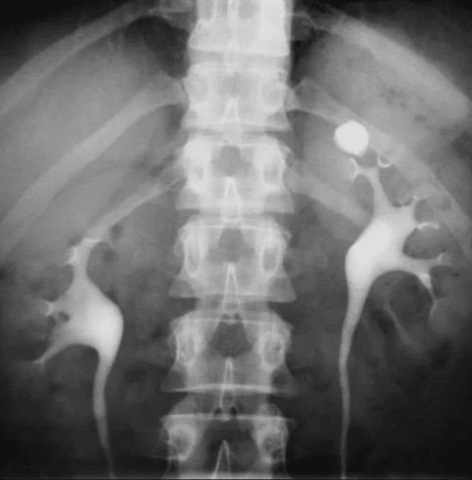 x ray kidney stone
