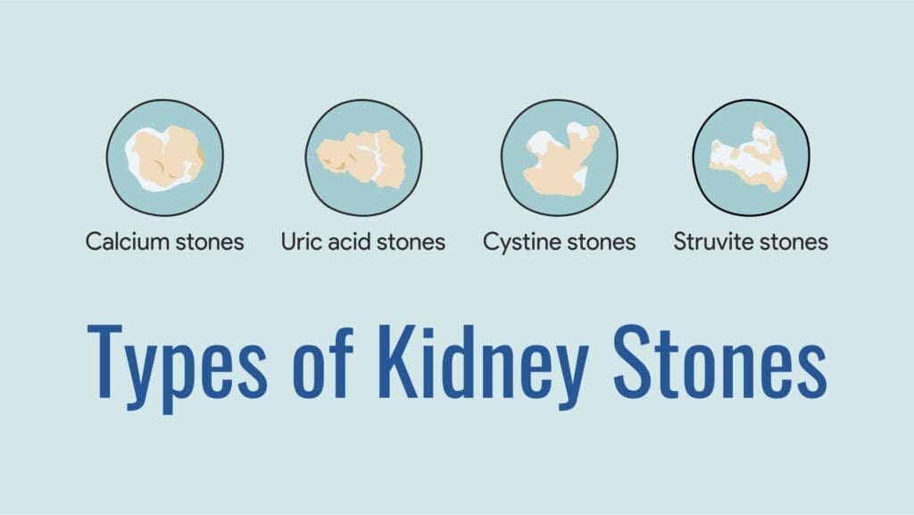 types of kidney stones