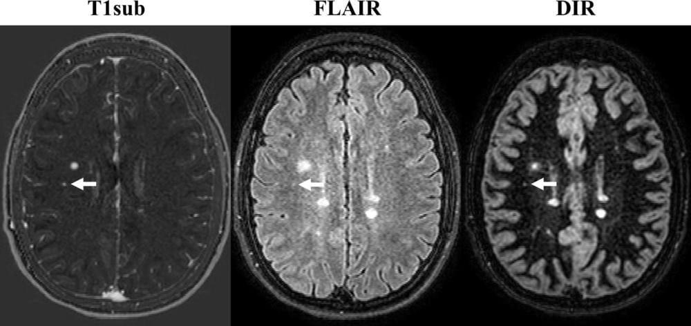 mri contrast brain