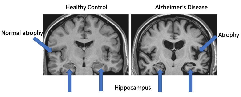 brain mri