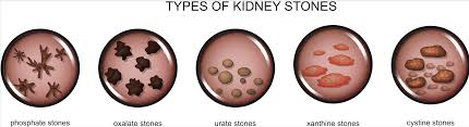 types of kidney stones