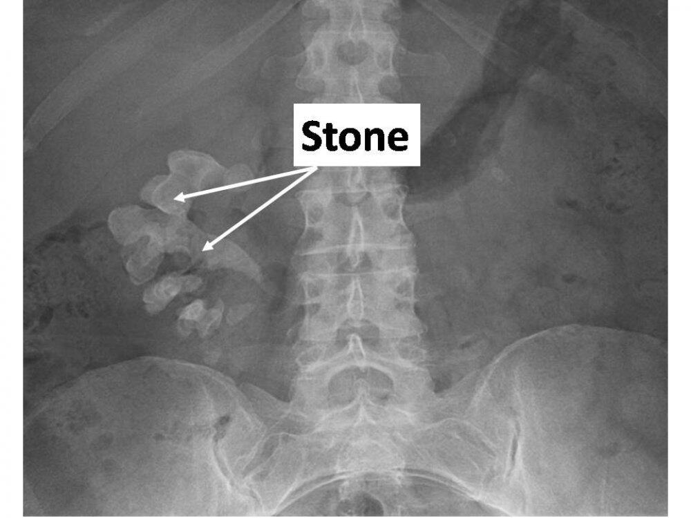 stones