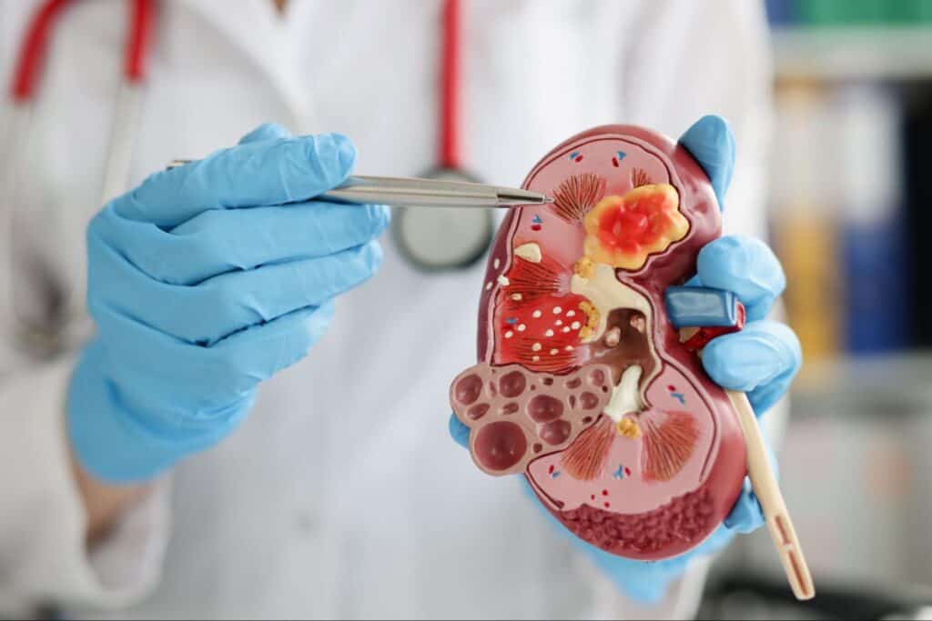 Do Kidney Stones Show on CT Scan